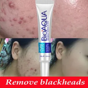 Acne Treatment Blackhead Removal Anti Acne Cream Oil Control